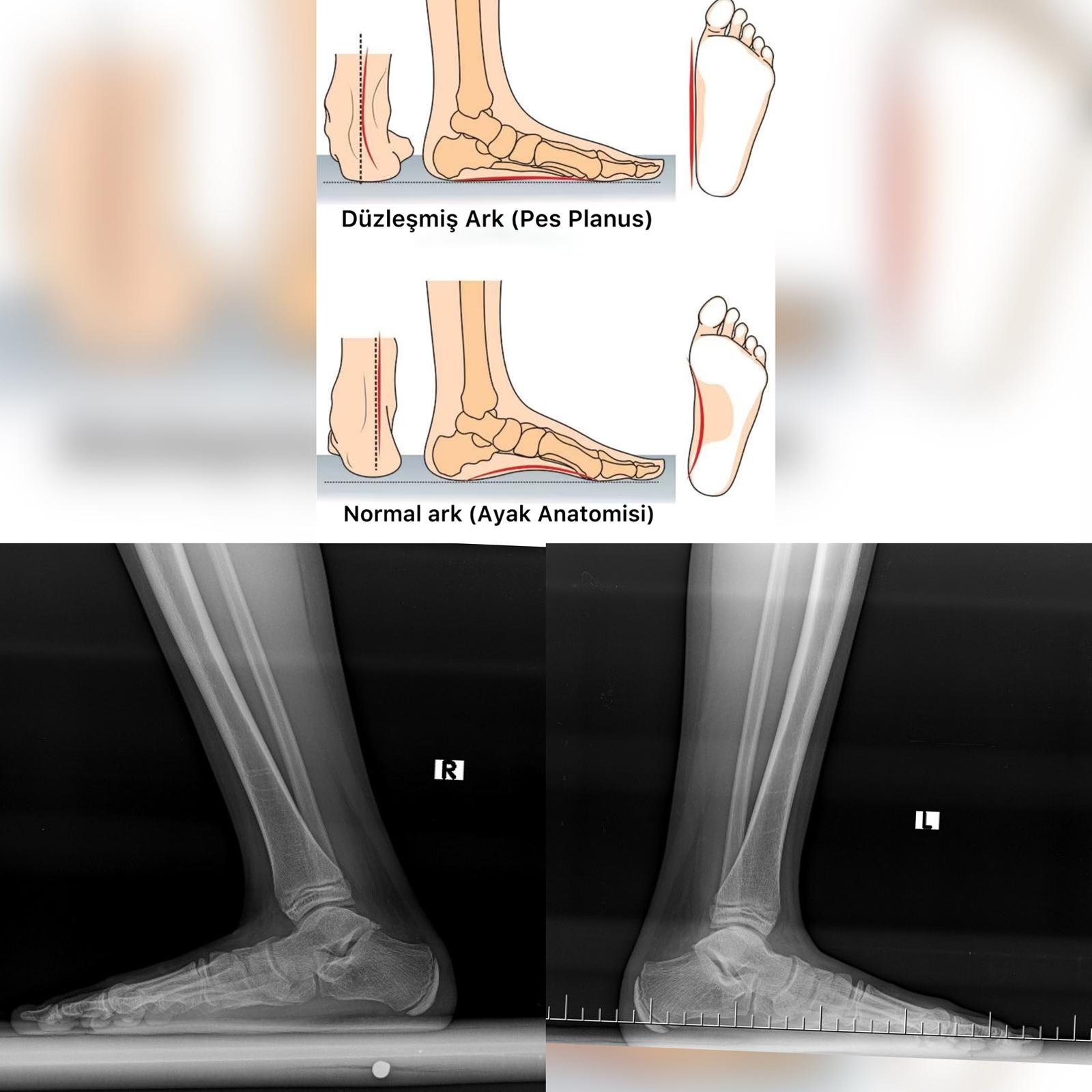 Düz Tabanlık(Pes Planus)