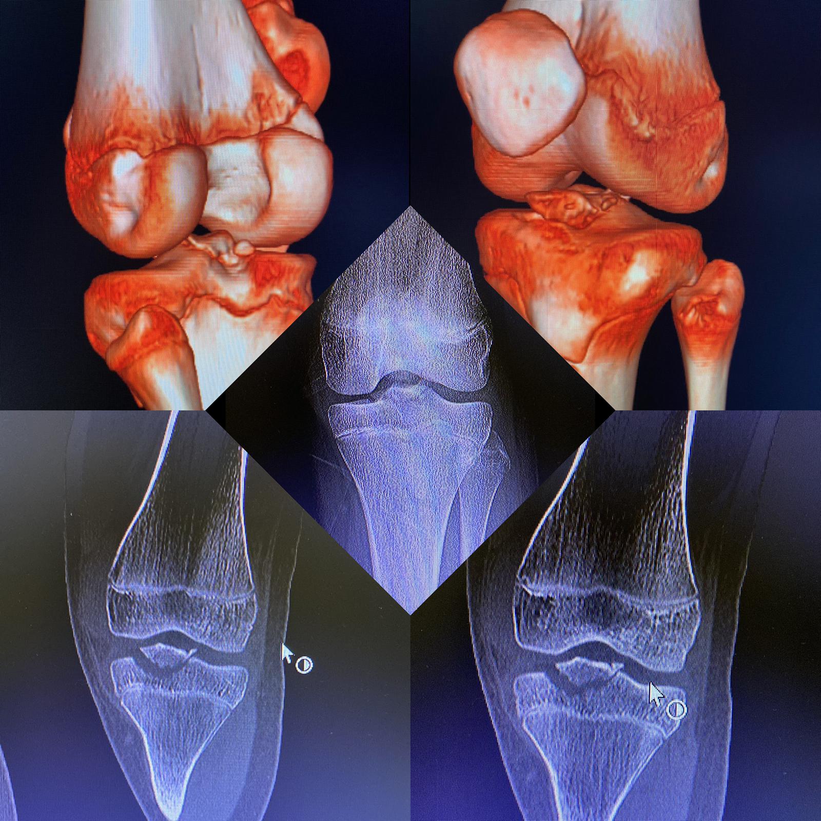 Diz İçi Tibia Eminensia Kırıkları Nedir ve Nasıl Tedavi Edilir?